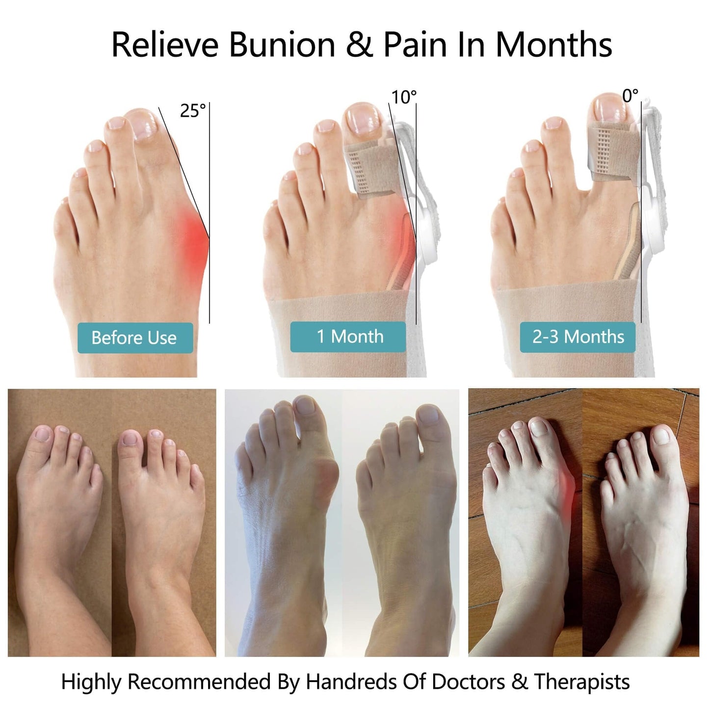 🔥Big Promotion 49% OFF💥Orthopedic Bunion Corrector
