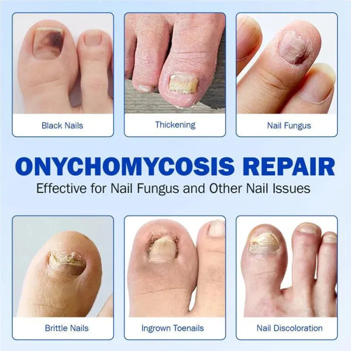 Nail Health Care Patches, Nail Fungus Care Patches, Suitable for Solving Fungal Nails and Other Nail Problems(21 Patches)